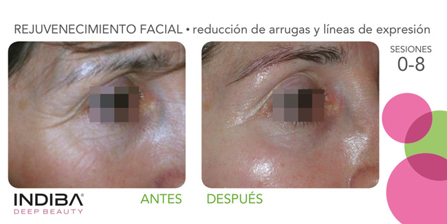 INDIBA antes y después tratamiento facial antiarrugas