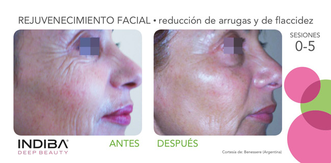 INDIBA antes y después tratamiento facial antiarrugas