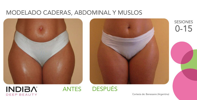 Tratamiento corporal INDIBA antes y después - modelado caderas, abdomen y muslos