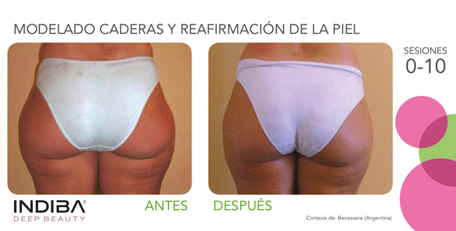 Tratamiento corporal INDIBA antes y después - modelado caderas y reafirmación de la piel