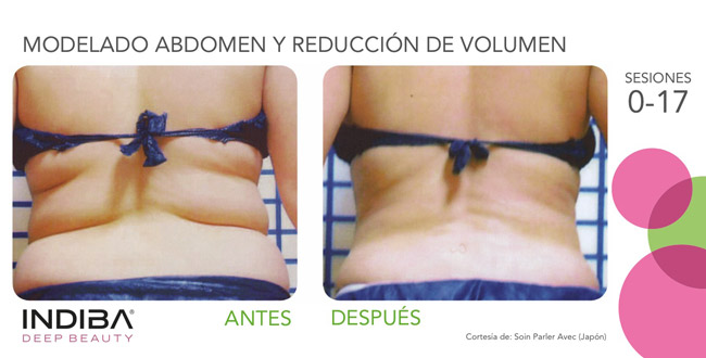 Tratamiento corporal INDIBA antes y después - modelado abdomen y reducción de volumen