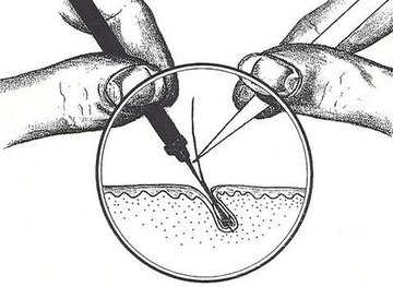 Filamentos en la depilación eléctrica