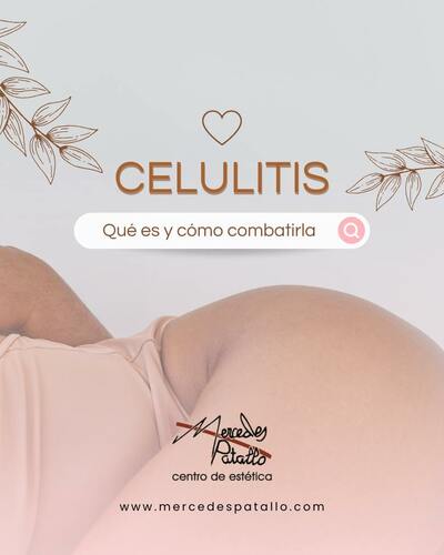 CELULITIS: Qué es y cómo combatirla