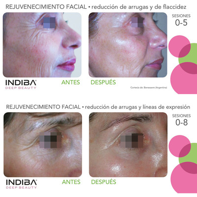 Vídeo Tratamiento INDIBA Deep Beauty Rejuvenecimiento Facial